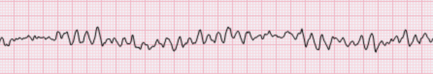 Fibrilación Ventricular