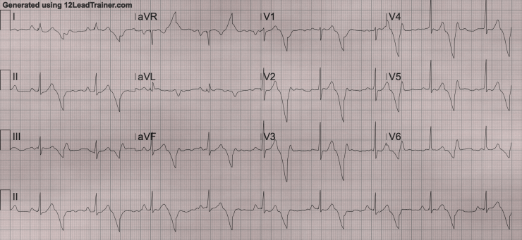 bigeminismo ventricular
