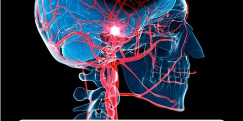 Alteplasa para stroke entre 4.5 y 24 horas: el estudio HOPE