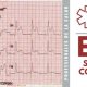 ECG: Síndrome Coronario Agudo