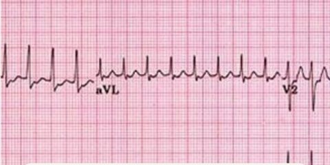 Adenosina en taquicardia supraventricular inestable fuera del hospital: una nueva mirada al manejo prehospitalario