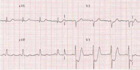 Más allá del STEMI: Patrones de EKG de alto riesgo como predictores de infarto oclusivo en pacientes con paro cardíaco extrahospitalario