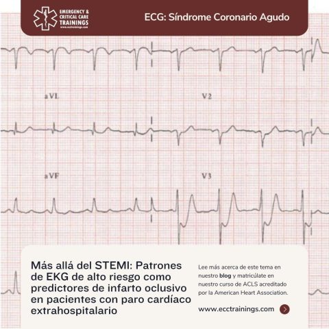 Más allá del STEMI: Patrones de EKG de alto riesgo como predictores de infarto oclusivo en pacientes con paro cardíaco extrahospitalario