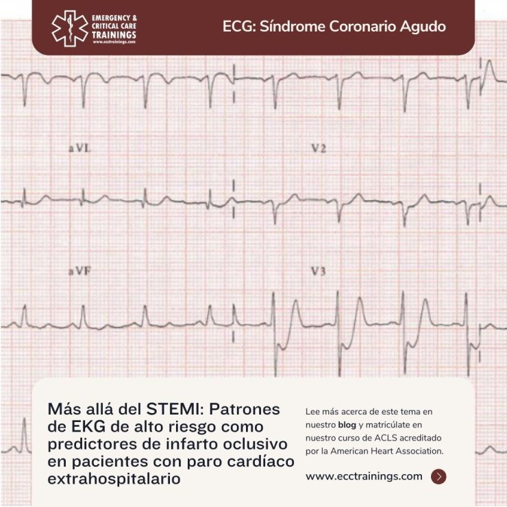 Más allá del STEMI: Patrones de EKG de alto riesgo como predictores de infarto oclusivo en pacientes con paro cardíaco extrahospitalario