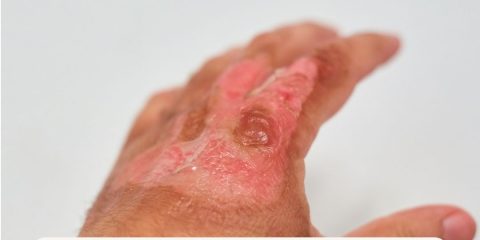 Cuidado de quemaduras en zonas remotas versus combate: lecciones cruzadas entre las guías JTS y WMS